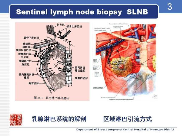 图解乳腺癌前哨淋巴结活检术