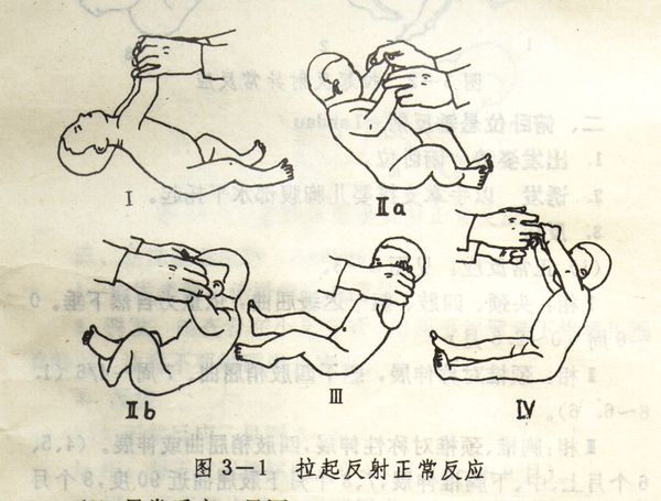 中枢性协调障碍