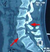 腰椎峡部裂,滑脱