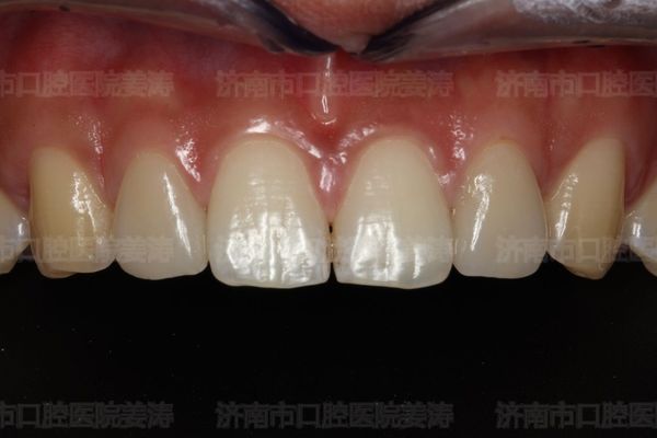 全瓷贴面修复畸形牙 - 好大夫在线