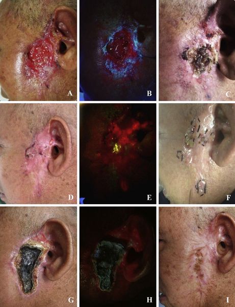 左侧面部鳞癌荧光诊断和光动力治疗
