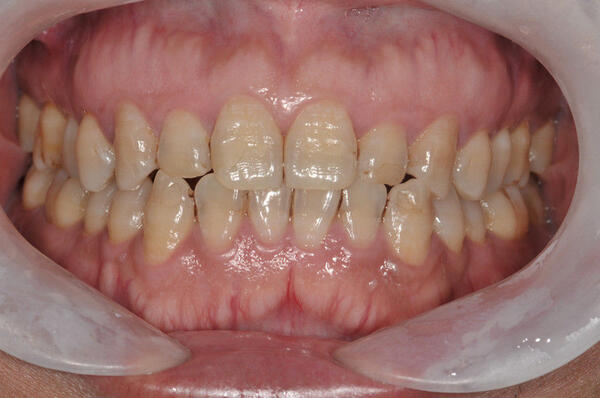 患者前牙釉质发育不全,术前照片.