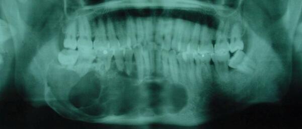 成釉细胞瘤--最常见的颌骨牙源性肿瘤