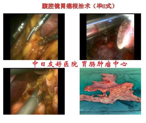 腹腔镜胃癌根治术(毕ii式吻合)