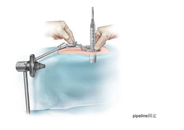 小切口解决大问题:腰椎微创手术 MIS-TLIF技术