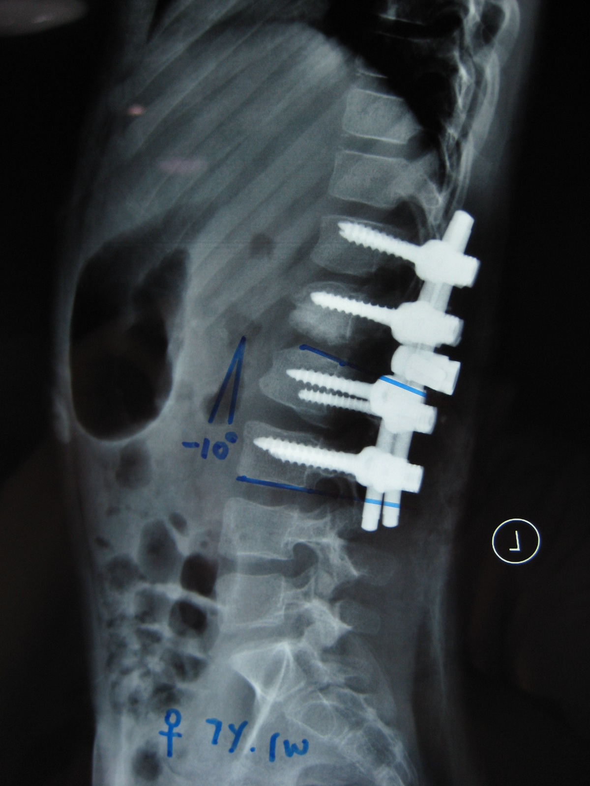 经后路半椎体切除手术矫治先天性脊柱侧后凸畸形附图片资料