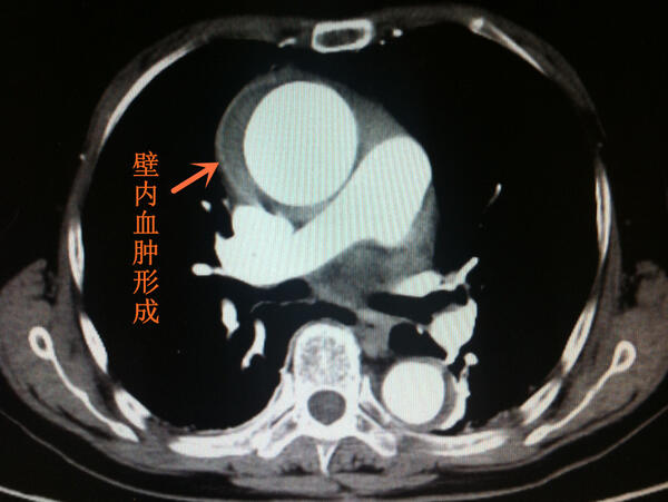 主动脉夹层ct显示和术中图片比较