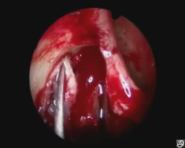 慢性泪囊炎的微创手术治疗--鼻内镜下鼻腔泪囊