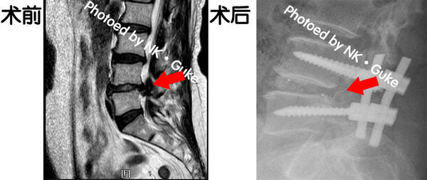 腰椎间盘突出症——腰椎后路减压椎弓根钉内固定术