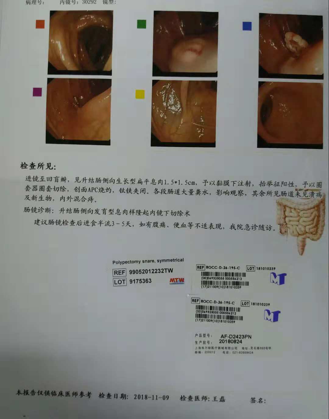 3天内发现3例4处结肠侧向发育型肿瘤