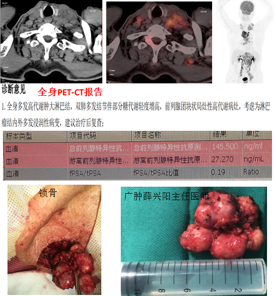 特殊病例—一例因声嘶,锁骨上淋巴结肿大为首发症状前列腺癌诊治(广州