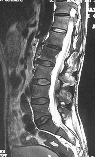 经椎旁肌间隙后外侧腰椎间孔入路手术治疗腰椎