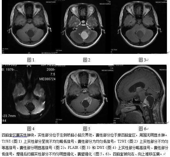 四脑室区神经鞘瘤一例