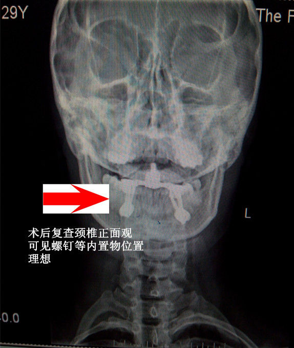 术后颈椎正位片