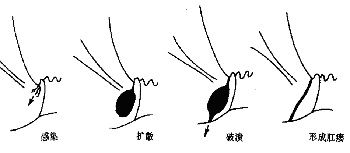 肛瘘的病因、临床表现与预防