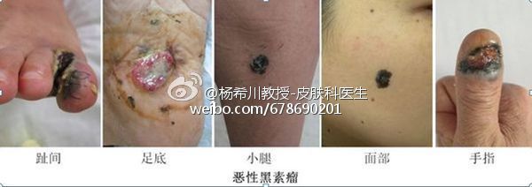 首先要明确是先天性还是后天性, 先天性巨痣最易恶变,其次为先天性