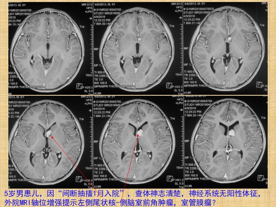 神经内镜经endoport技术切除5岁儿童侧脑室肿瘤1例