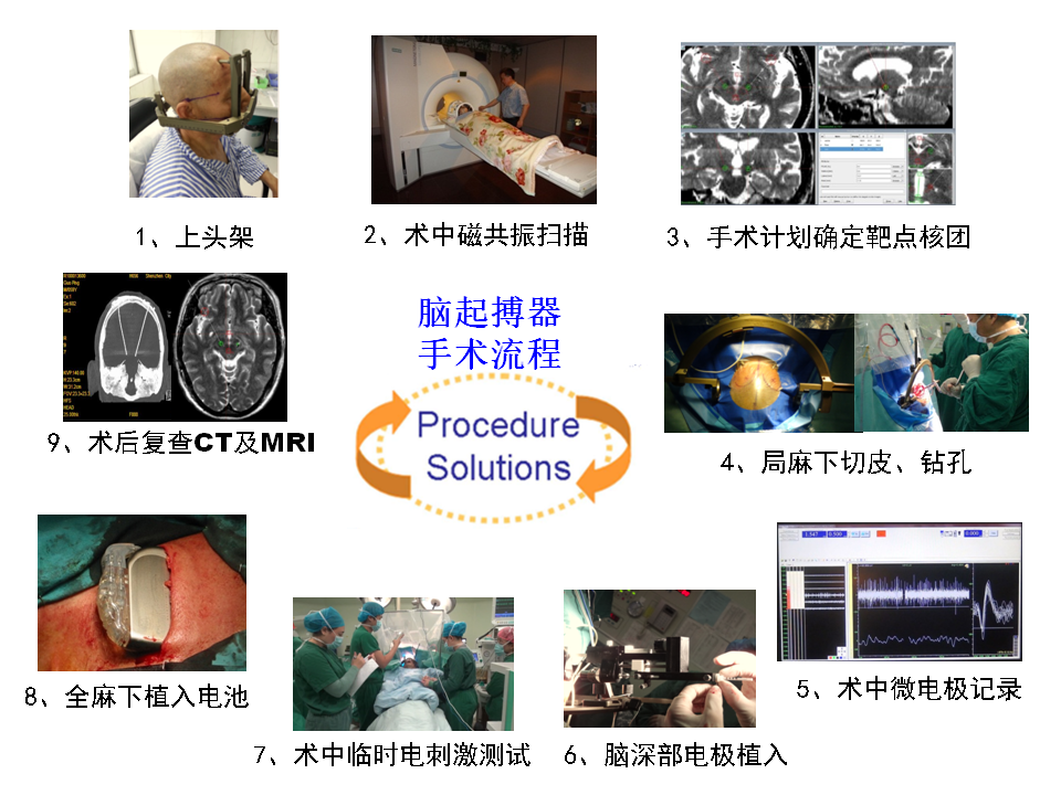 病患者的故事 小编:以双侧丘脑底核脑深部电刺激术治疗帕金森病为例