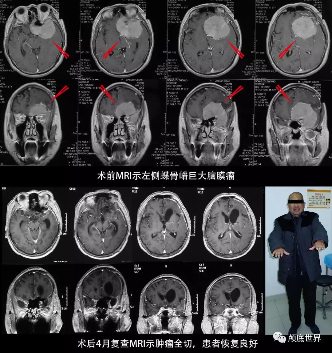 6 巨大蝶骨嵴脑膜瘤