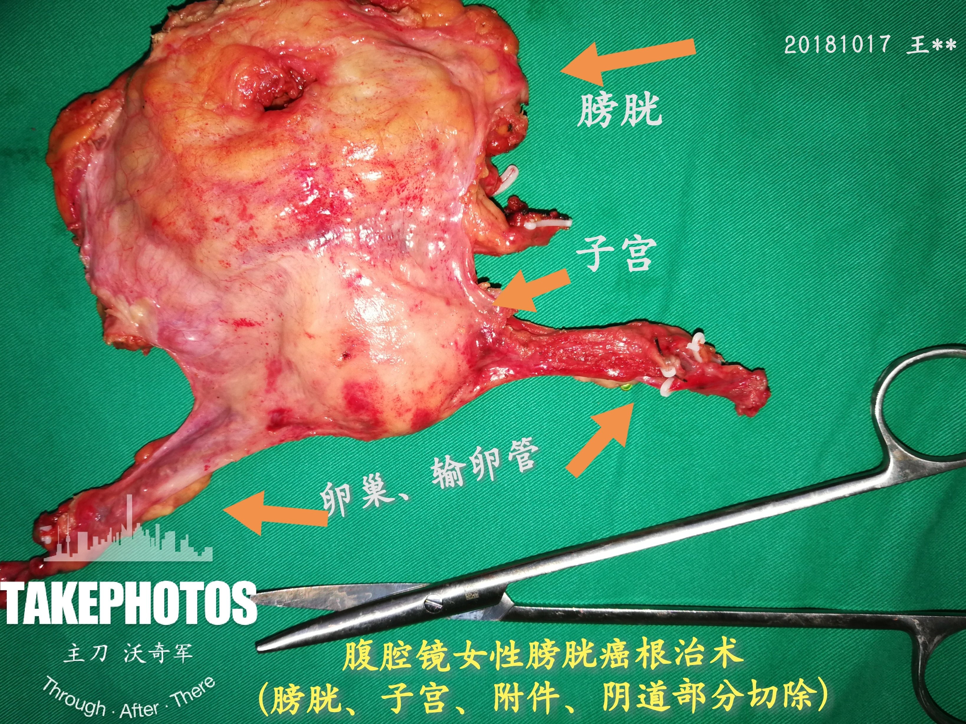 沃医生主刀手术12:腹腔镜女性膀胱癌根治术