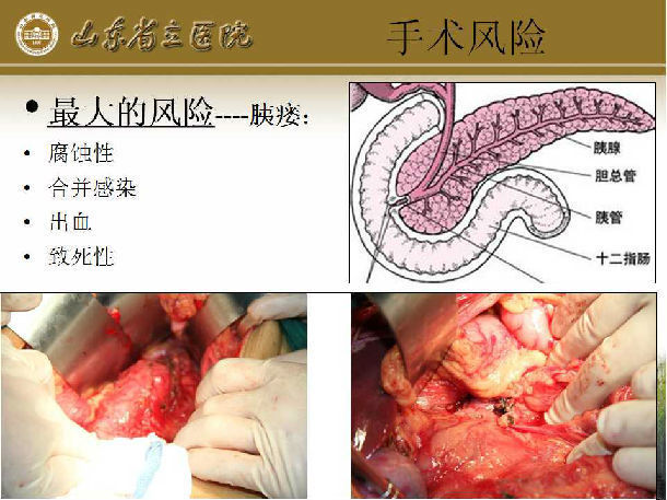 胰体尾 脾切除术手术须知