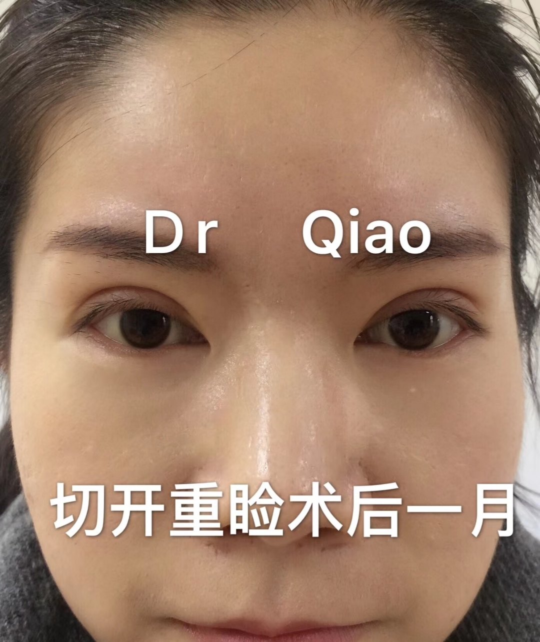 双眼皮手术能解决轻度的上眼睑下垂