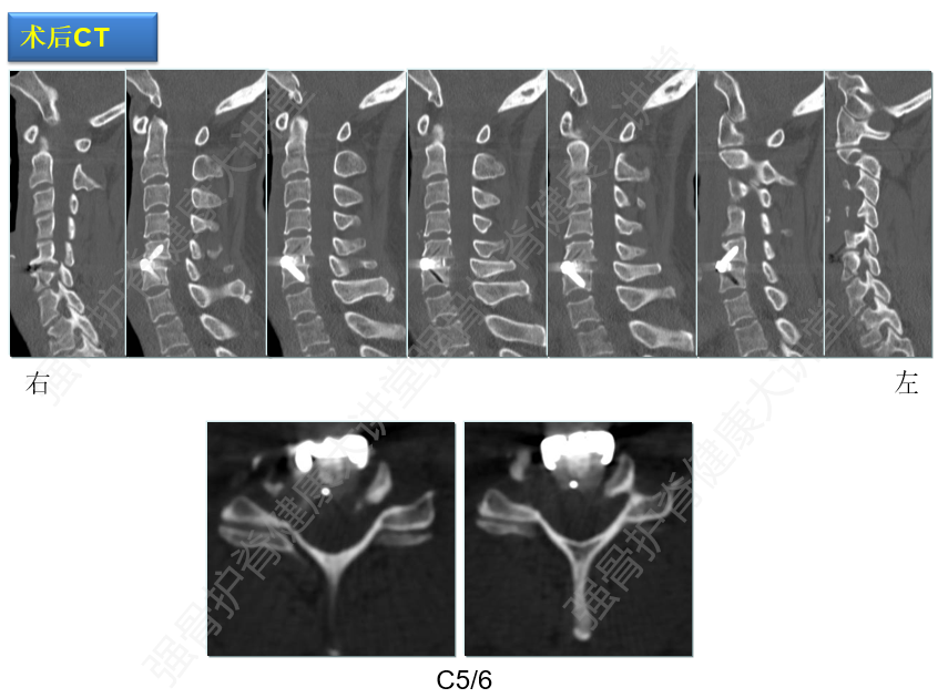 影像检查示颈髓受压,致压物是c5/6间盘及c5椎体后缘增生骨赘.
