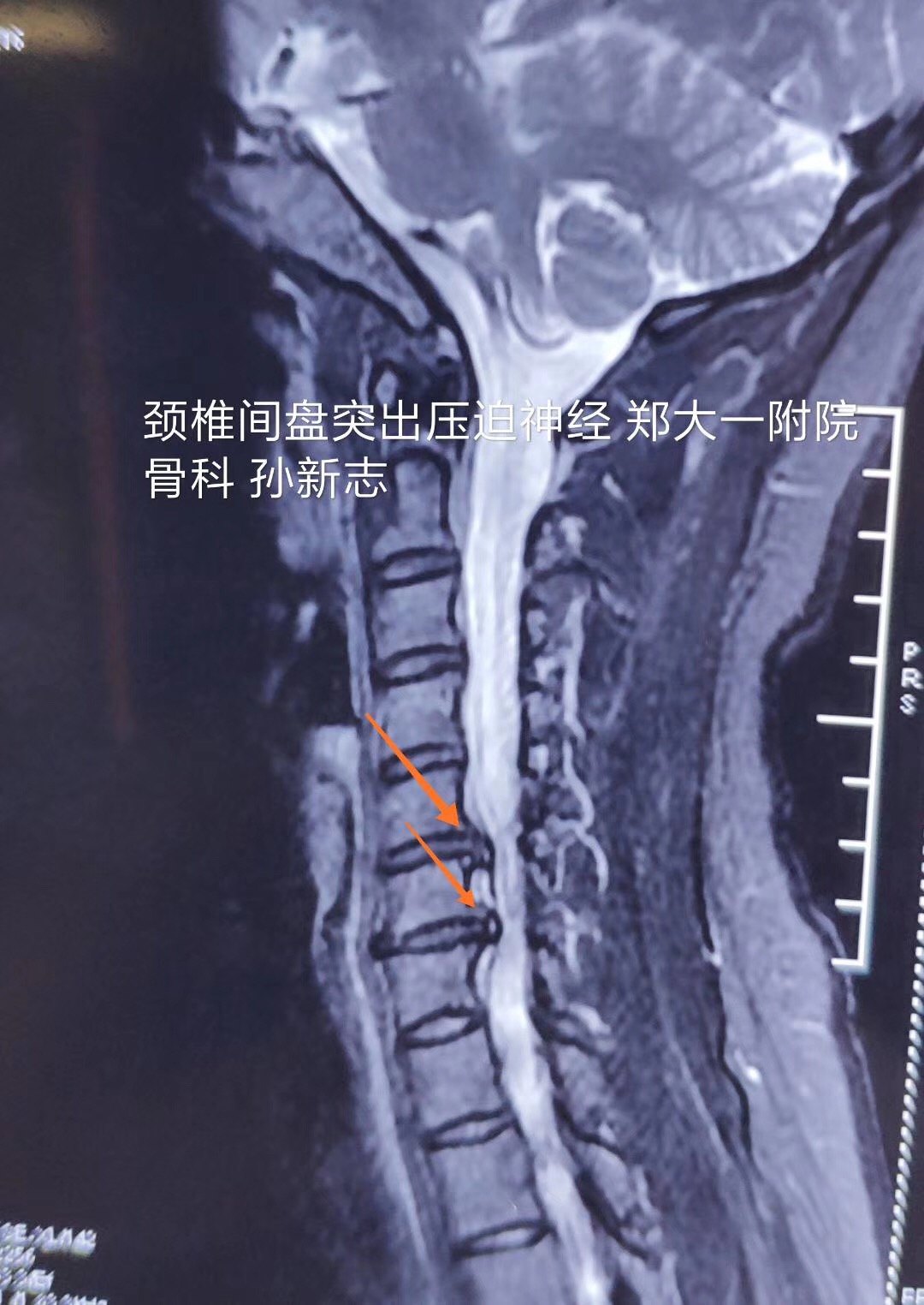 孙新志教授:颈椎微创手术-病例34