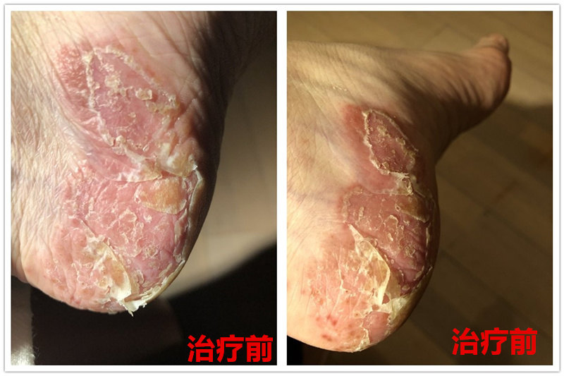 掌跖脓疱病治疗实例