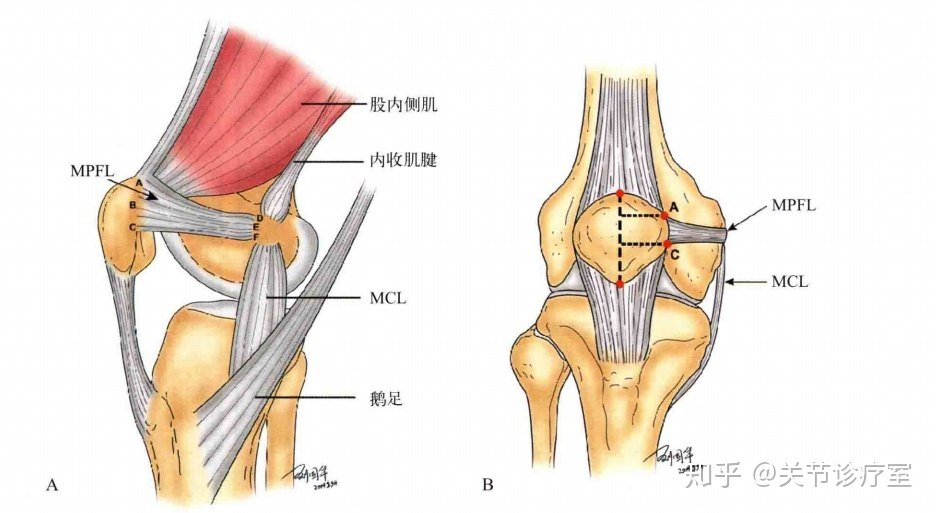 从左至右:正常,半脱位,脱位 内侧髌骨韧带的撕裂 在髌骨内侧有一条