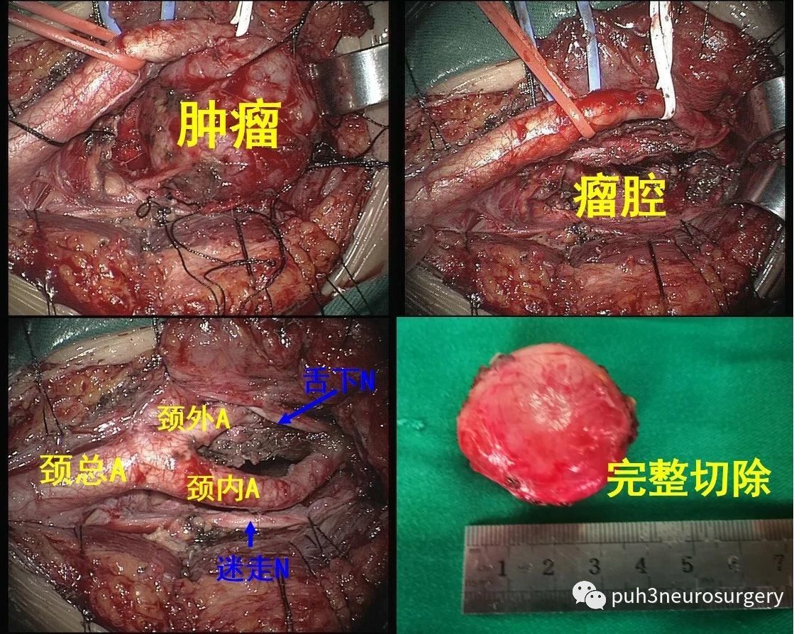 易被误诊为颈动脉体瘤的颈动脉分叉部肿瘤全切体会