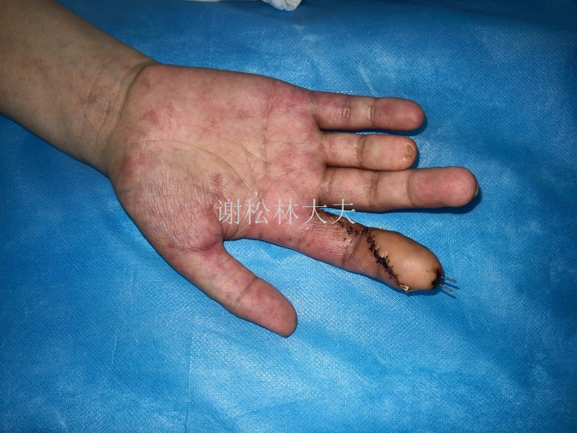 目前手指缺损再造的常见方法主要如下:残端指骨或掌骨截骨延长;其他