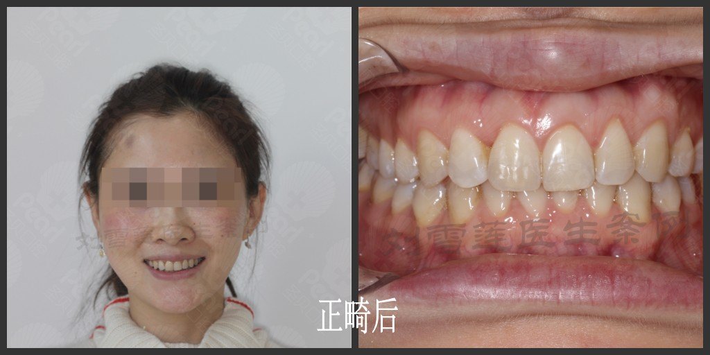 上前牙扭转隐形矫正案例分享