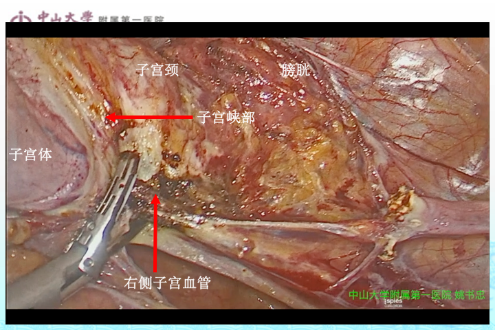 你应该了解的腹腔镜子宫切除术