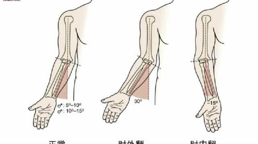 肘内翻畸形发病机制和治疗方式?_先天性骨与关节畸形