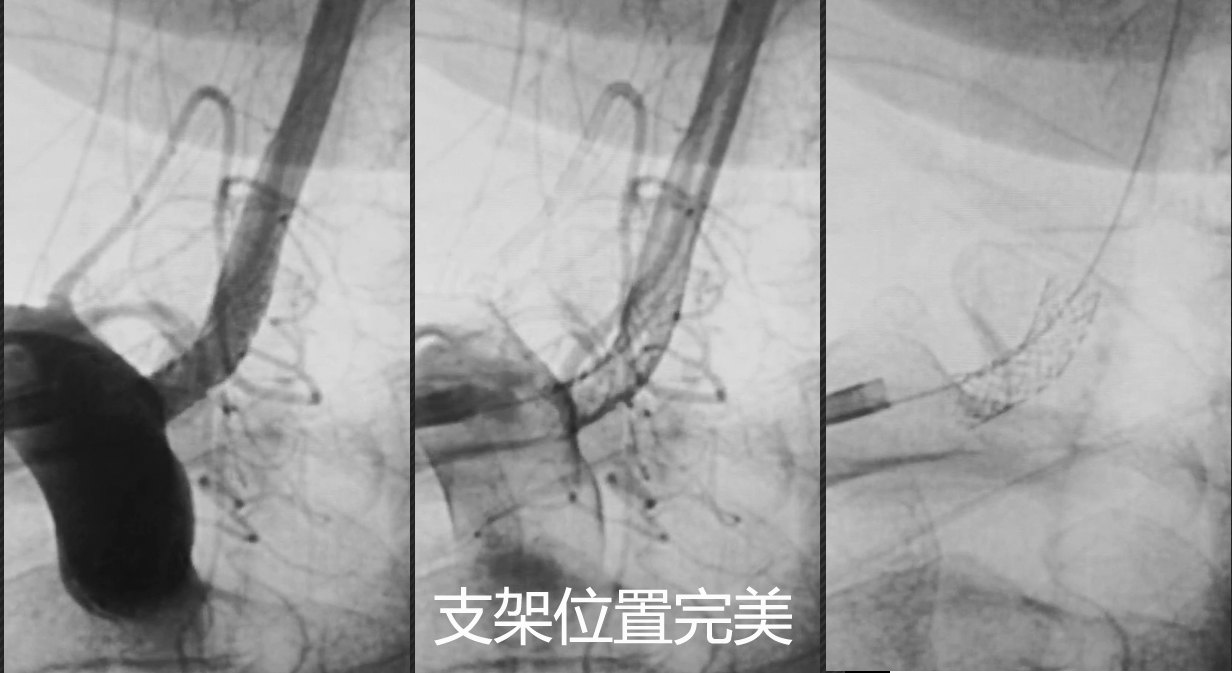 典型病例椎动脉狭窄支架成形术