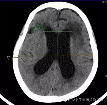 脑积水,不一定颅压高
