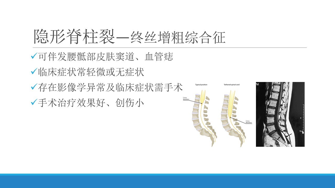 脊柱裂的常见类型及治疗原则_脊柱裂_症状_预防_手术_治疗方法 - 好