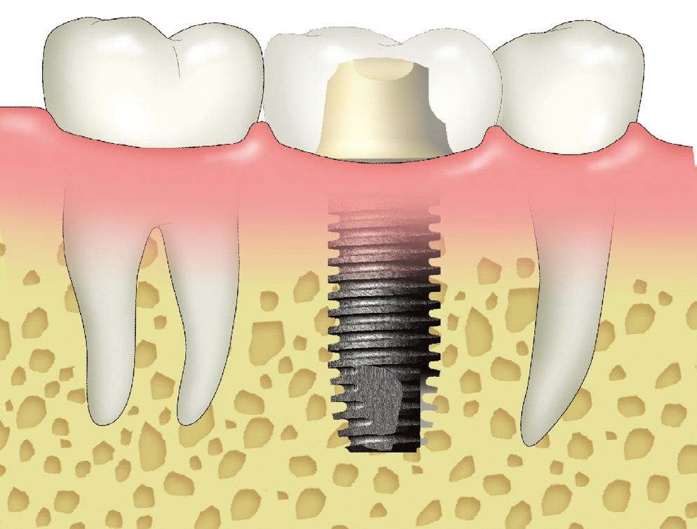 (4)种植牙人工牙根与天然牙牙根的区别:在后牙区通常选择单颗种植体