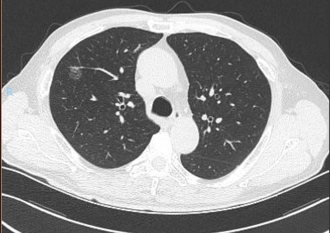 体检发现肺"磨玻璃结节"的一例早期肺癌