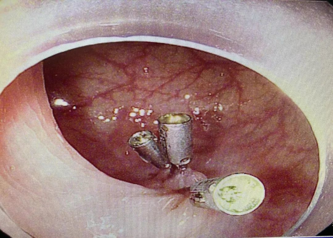 息肉切除后打的钛夹最后都去哪了?