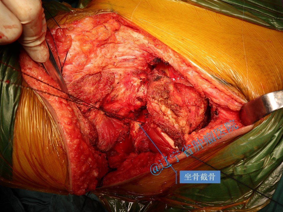 骨盆尤文肉瘤手术病例