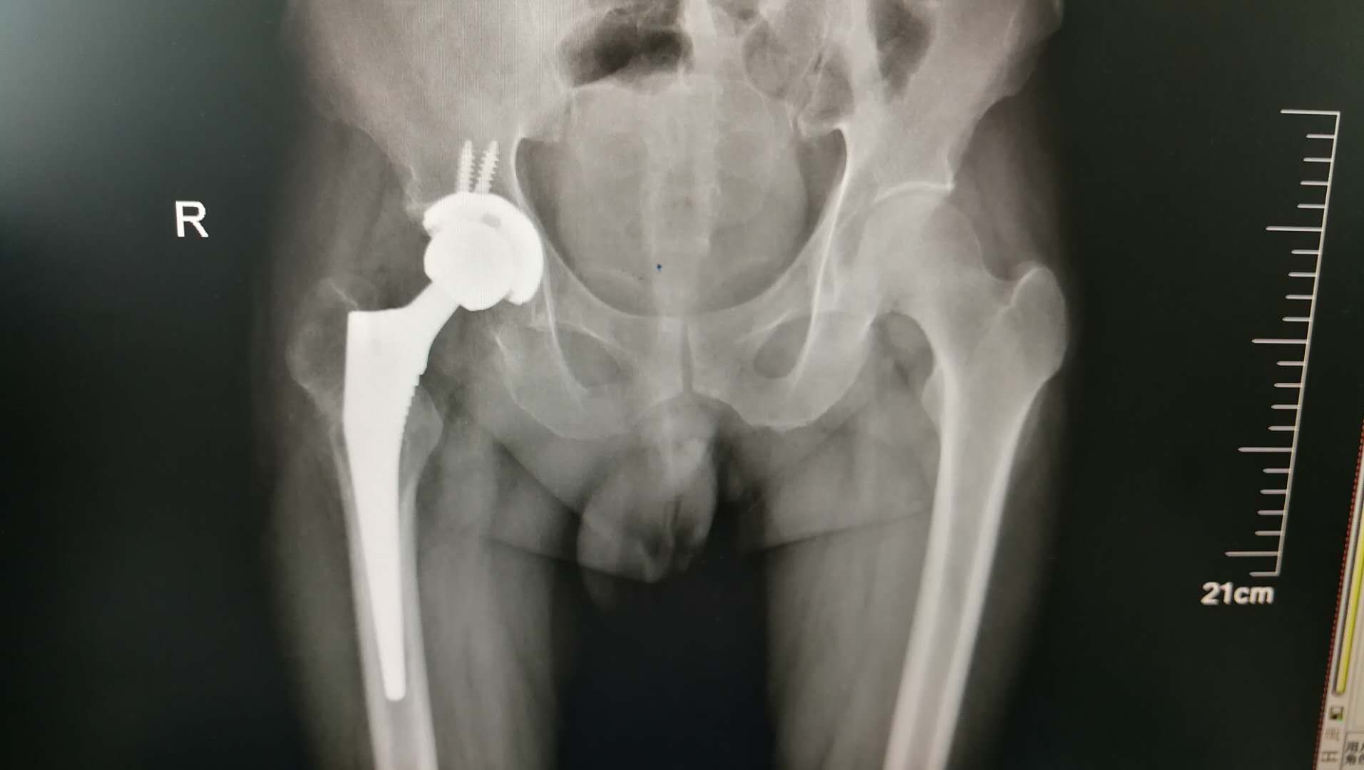 由于骨质疏松引起股骨颈的强度下降,加上股骨颈特殊的结构,所以老年人
