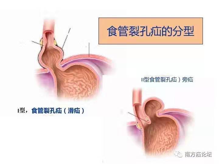 反酸,烧心好不了?小心食道裂孔疝～_食管裂孔疝_症状_手术_治疗方法-