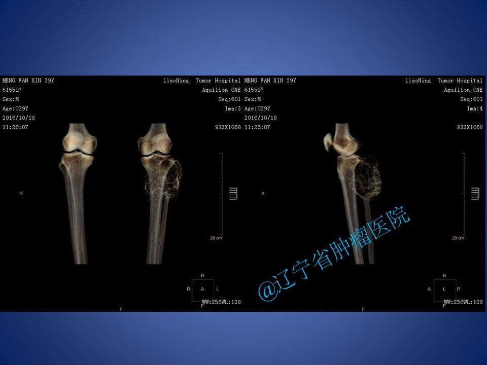 腓骨近端骨巨细胞瘤手术病例