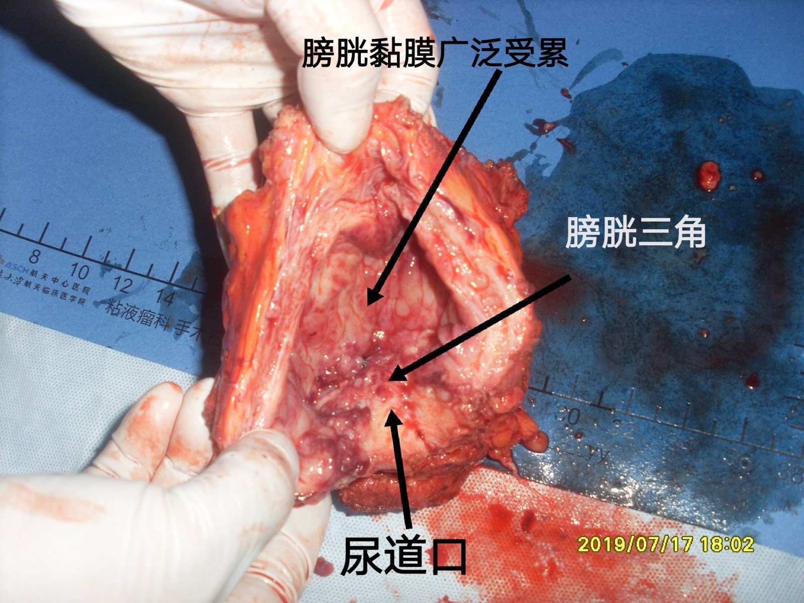 病例100--直肠腺癌也可以直接浸润累及卵巢形成卵巢