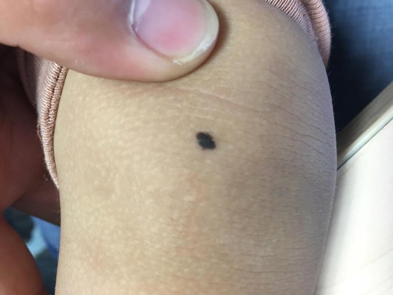 关于皮肤鳞癌,恶性黑色素瘤,皮肤痣,指甲痣的区别您知道吗?