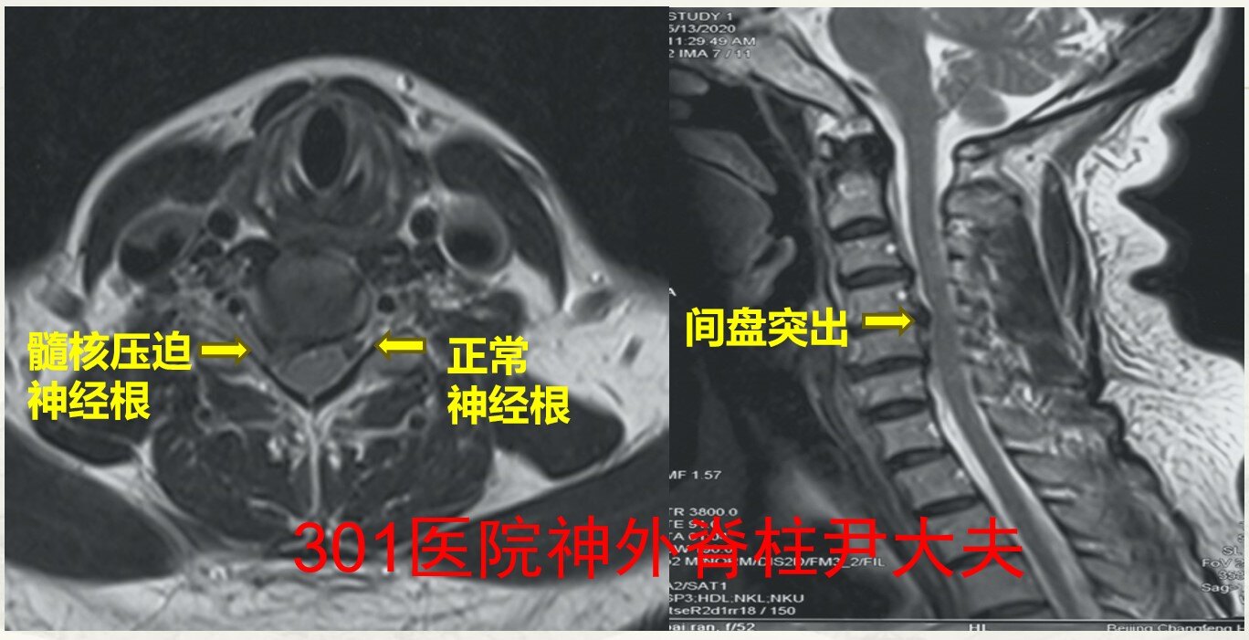性畸形 如先天性寰椎枕化,klippel-feil综合征等导致颈椎其