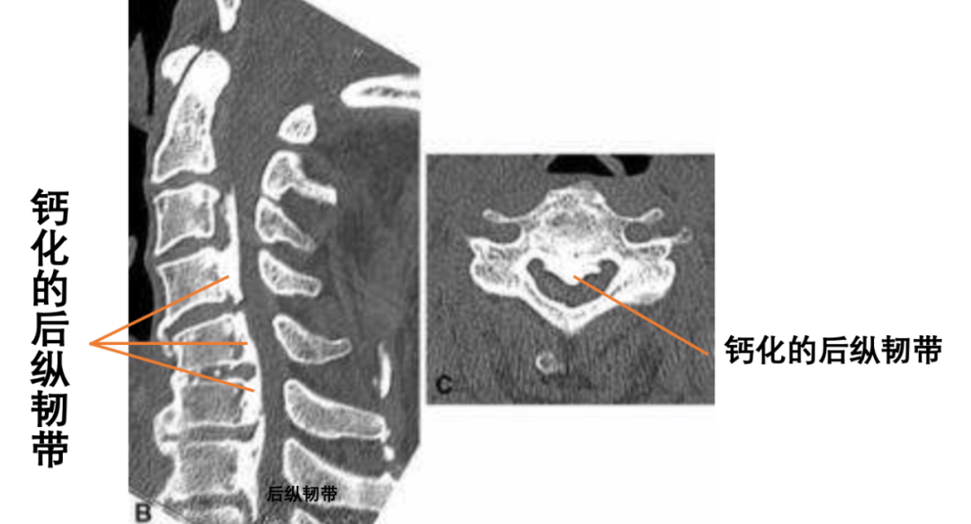 沈凯 > 双腿乏力的元凶竟然是颈椎病---脊髓型颈椎病 韧带钙化 和 骨