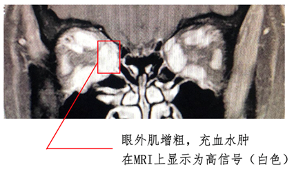 graves眼病系列病例③眼眶放射治疗